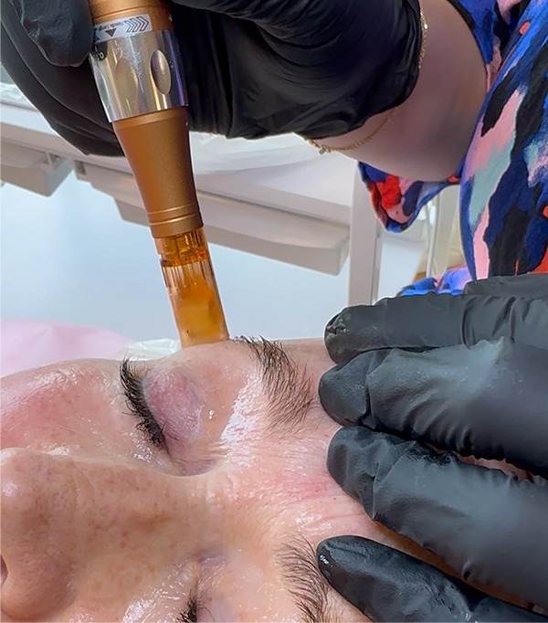 Face contouring mesotherapy procedure