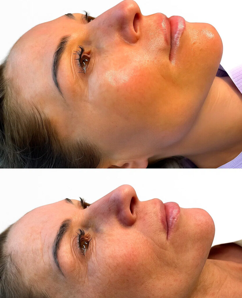 BB Glow skin rejuvenation result
